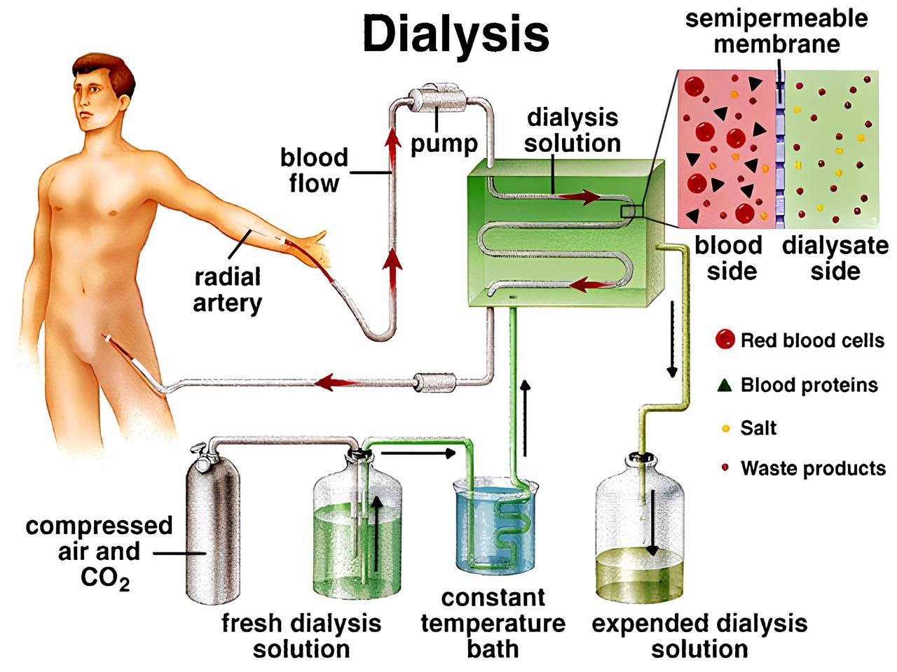 Dialysis Diagram